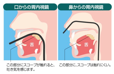 経口内視鏡検査と経鼻内視鏡検査