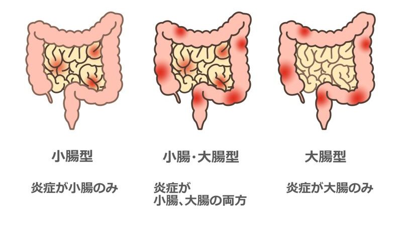 クローン病とは