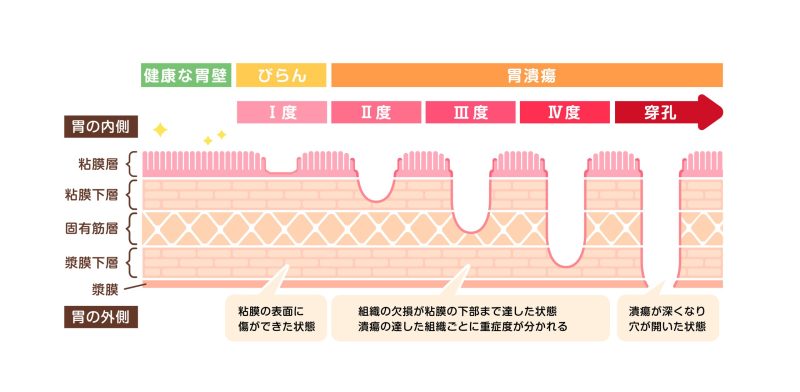 慢性胃炎、胃・十二指腸潰瘍とは