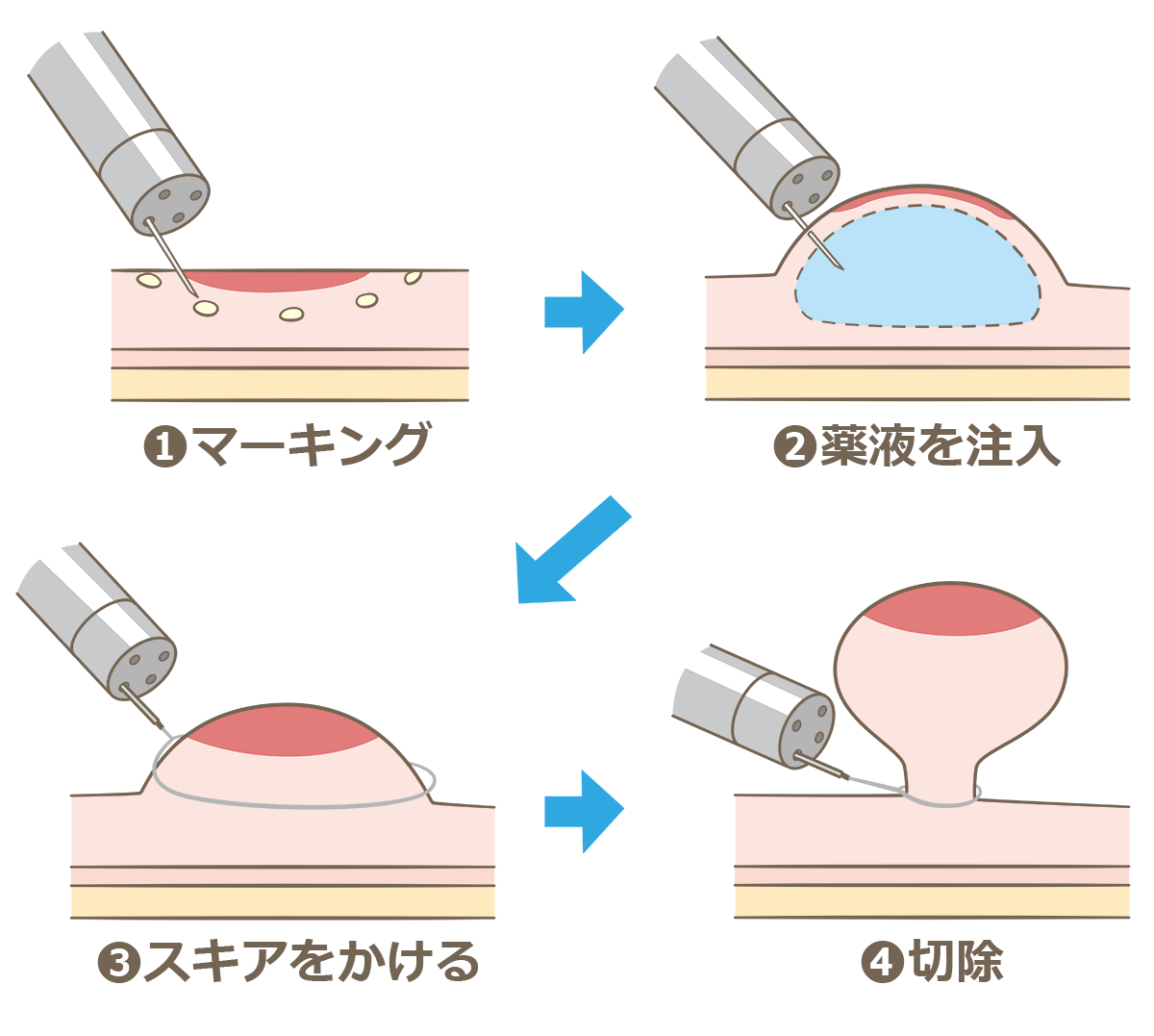 内視鏡的粘膜切除術（EMR）とは