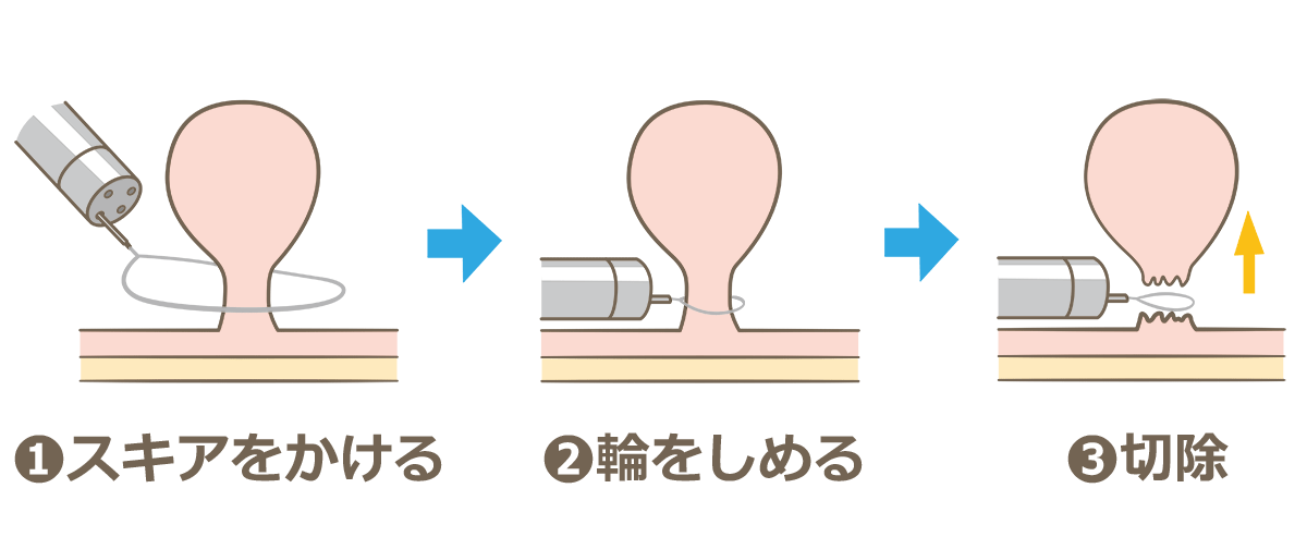 ポリペクトミーとは