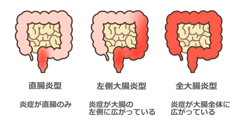 潰瘍性大腸炎とは